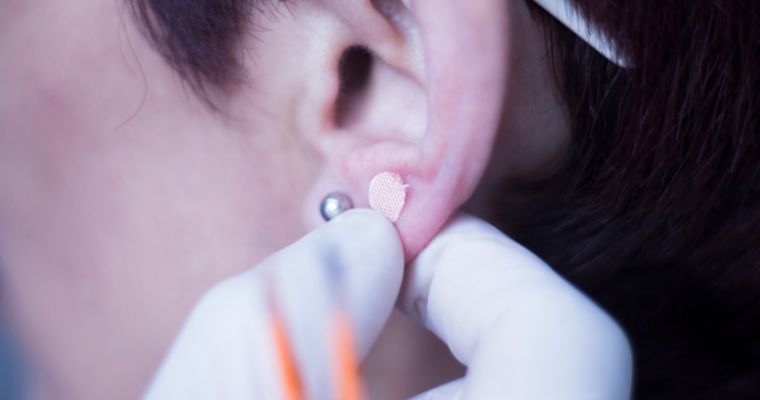 Auriculotherapy Ear Seed Treatment